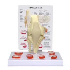 3B Kneledd - Menisk 6 ulike rupturer