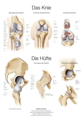Plakat The Knee &amp; Hip AL551 50 x 70 cm Plast